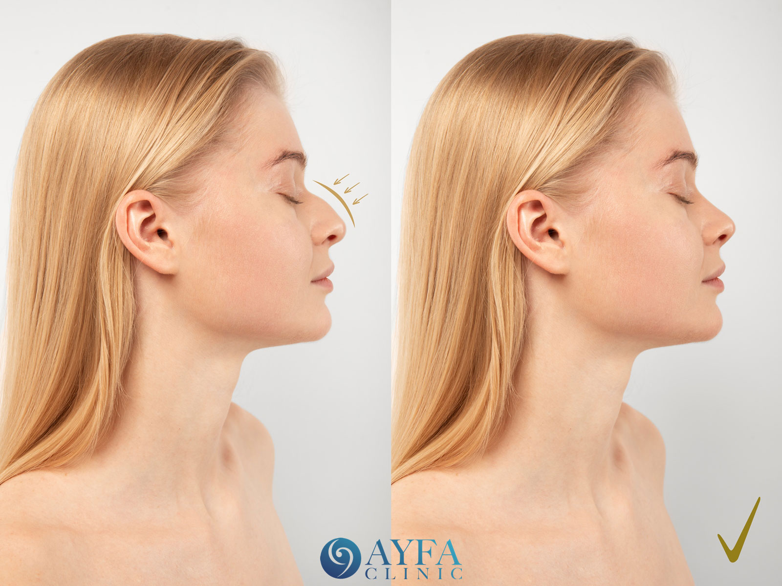 Rhinoplastik Türkei