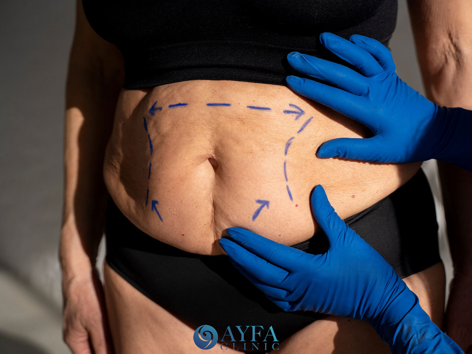 Estética postparto Turquía