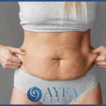 Precios de la cirugía de eliminación de grasa en Turquía