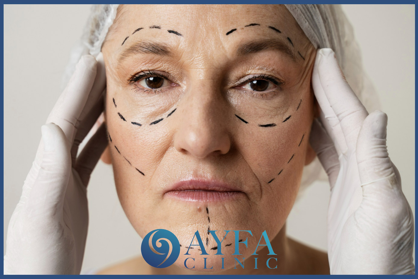 Cirugía de Lifting Facial Turquía