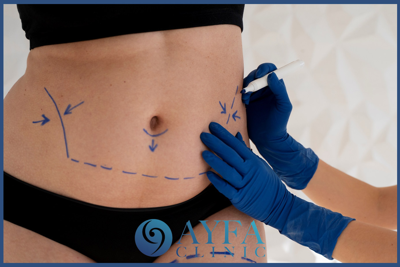 tummy tuck turkey