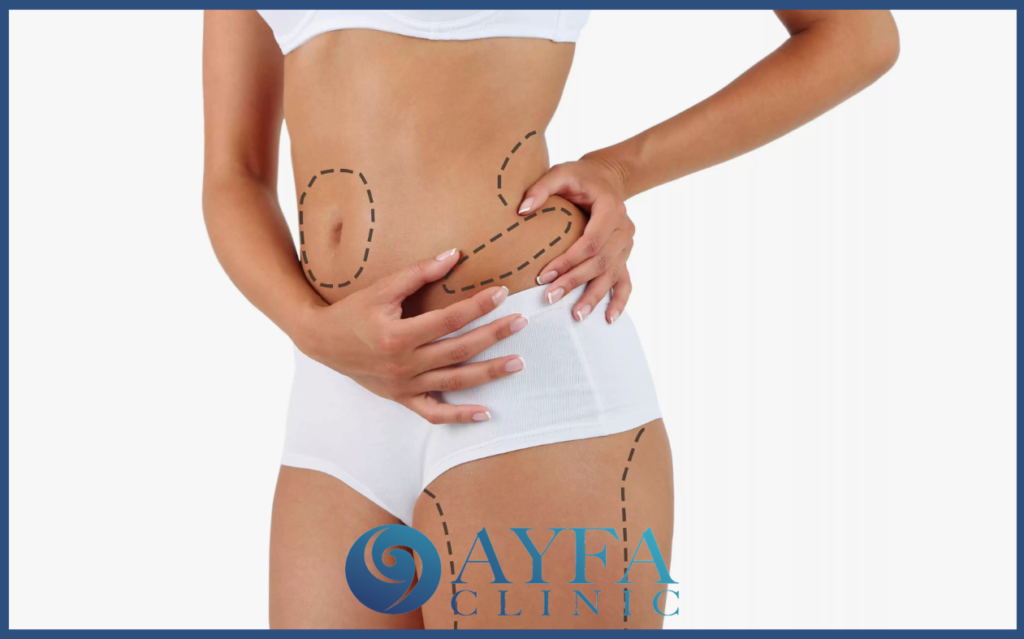 When Liposuction Turkey