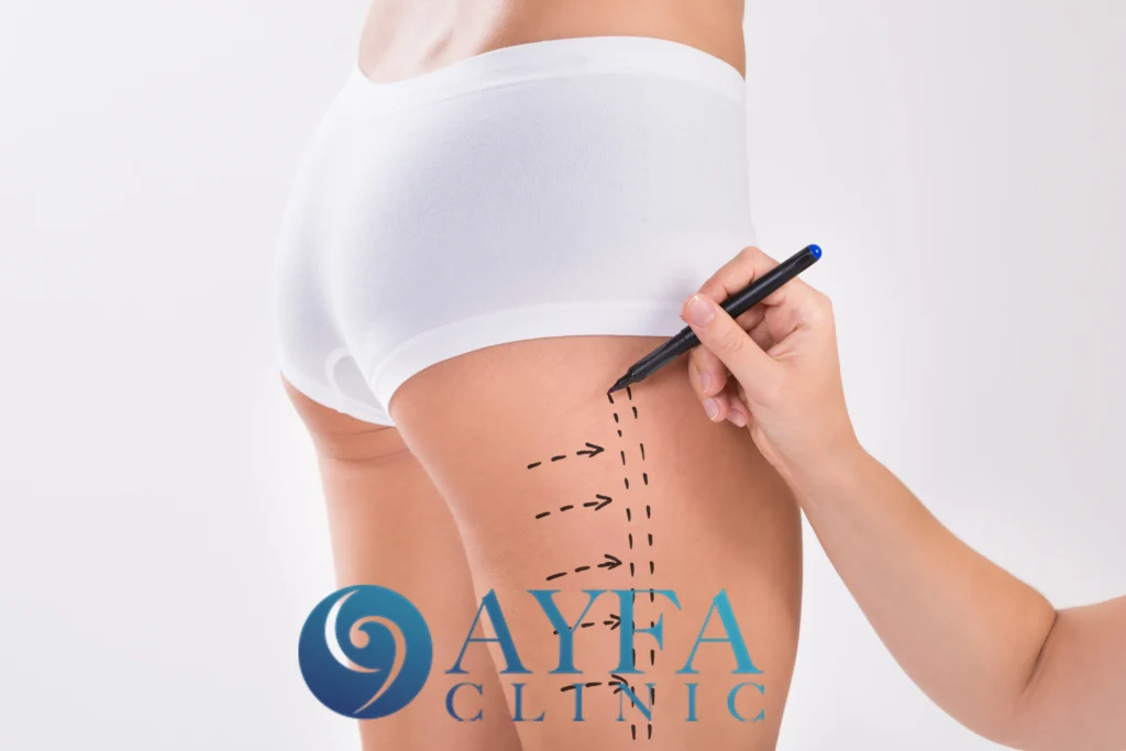 Thigh Lift Surgery Turkey